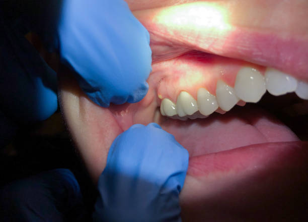 Best Cracked Tooth Emergency Dentist  in Schuylkill Haven, PA